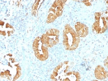 IHC testing of FFPE human rectum tissue with Villin antibody (clone VIL1/1314). Required HIER: boil tissue sections in 10mM citrate buffer, pH 6, for 10-20 min followed by cooling at RT for 20 min.~