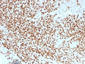 IHC testing of FFPE Ewings sarcoma with NKX2.2 antibody (clone NX2/1523). HIER: steam sections in pH 9 10mM Tris with 1mM EDTA for 10-20 min.~