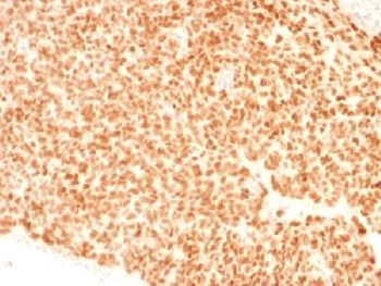 IHC testing of FFPE Ewings sarcoma with NKX2.2 antibody (clone NX2/1523). HIER: steam sections