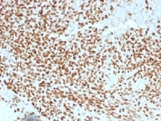 IHC testing of FFPE Ewings sarcoma with NKX2.2 antibody (clone NX2/1523). HIER: steam sections in pH 9 10mM Tris with 1mM EDTA for 10-20 min.