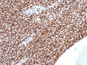IHC testing of FFPE Ewings sarcoma with NKX2.2 antibody (clone NX2/1524). HIER: steam sections in 10mM citrate buffer, pH 6, for 10-20 min.~