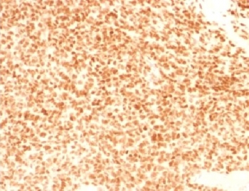 IHC testing of FFPE Ewings sarcoma with NKX2.2 antibody (clone NX2/1524). HIER: steam sections i