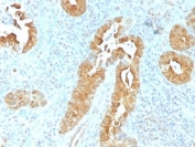 IHC testing of FFPE human rectum tissue with Villin antibody (clone VIL1/1325). Required HIER: boil tissue sections in 10mM citrate buffer, pH 6, for 10-20 min followed by cooling at RT for 20 min.