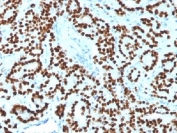 IHC testing of FFPE human prostate carcinoma with FOXA1 antibody (clone FOXA1/1518). HIER: boil sections in 10mM Tris with 1mM EDTA, pH9, for 10-20 min.