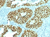IHC testing of FFPE human cervical carcinoma with SOX2 antibody (clone SOX2/1792). Required HIER: boil tissue sections in 10mM citrate buffer, pH 6, for 10-20 min followed by cooling at RT for 20 min.