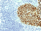 IHC testing of FFPE human cervical carcinoma with SOX-2 antibody (clone SOX2/1791). Required HIER: boil tissue sections in 10mM citrate buffer, pH 6, for 10-20 min followed by cooling at RT for 20 min.