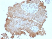 IHC testing of human bladder carcinoma with FAT2 antibody (clone 8C5). Required HIER: boil tissue sections in 10mM citrate buffer, pH 6, for 10-20 min followed by cooling at RT for 20 min.