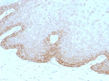 IHC testing of human cervical carcinoma with FAT2 antibody (clone 8C5). Required HIER: boil tissue sections in 10mM citrate buffer, pH 6, for 10-20 min followed by cooling at RT for 20 min.~