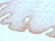 IHC testing of human cervical carcinoma with FAT2 antibody (clone 8C5). Required HIER: boil tissue sections in 10mM citrate buffer, pH 6, for 10-20 min followed by cooling at RT for 20 min.