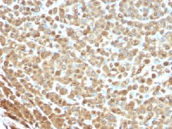 IHC testing of FFPE human melanoma stained with S100A1 antibody (clone S1-61). Required HIER: boil tissue sections in 10mM citrate buffer, pH 6, for 10-20 min followed by cooling at RT for 20 min.~