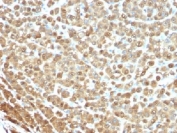 IHC testing of FFPE human melanoma stained with S100A1 antibody (clone S1-61). Required HIER: boil tissue sections in 10mM citrate buffer, pH 6, for 10-20 min followed by cooling at RT for 20 min.