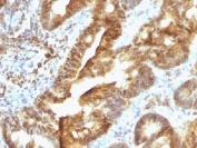 IHC testing of FFPE human colon carcinoma with TDP2 antibody (clone TDP2/1258). Required HIER: boil tissue sections in 10mM Tris with 1mM EDTA, pH 9, for 10-20 min followed by cooling at RT for 20 min.