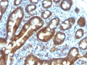 IHC testing of FFPE human duodenal carcinoma with TDP2 antibody (clone TDP2/1258). Required HIER: boil tissue sections in 10mM Tris with 1mM EDTA, pH 9, for 10-20 min followed by cooling at RT for 20 min.