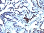 IHC testing of FFPE human lung carcinoma with TDP2 antibody (clone TDP2/1258). Required HIER: boil tissue sections in 10mM Tris with 1mM EDTA, pH 9, for 10-20 min followed by cooling at RT for 20 min.