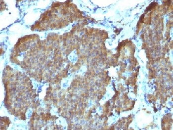 IHC testing of FFPE human pheochromocytoma with NSE antibody (clone SPM347). Required HIER: boil sections in pH 9 10mM Tris with 1mM EDTA for 10-20 min.~