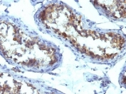 IHC testing of FFPE human testicular carcinoma with Alkaline Phosphatase antibody (ALPL/597). Required HIER: boil tissue sections in 10mM Tris with 1mM EDTA, pH 9, for 10-20 min followed by cooling at RT for 20 min.