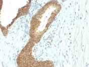 IHC testing of FFPE human colon carcinoma with Alkaline Phosphatase antibody (ALPL/597). Required HIER: boil tissue sections in 10mM Tris with 1mM EDTA, pH 9, for 10-20 min followed by cooling at RT for 20 min.