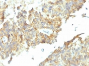 IHC testing of FFPE human ovarian carcinoma with Alkaline Phosphatase antibody (ALPL/597). Required HIER: boil tissue sections in 10mM Tris with 1mM EDTA, pH 9, for 10-20 min followed by cooling at RT for 20 min.