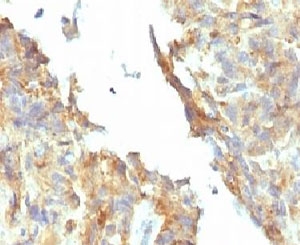 IHC testing of FFPE ovarian carcinoma and Alkaline Phosphatase antibody (KSUL-1). Required HIER: boil tissue sections in 10mM Tris with 1mM EDTA, pH 9, for 10-20 min followed by cooling at RT for 20 min.~