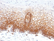 IHC testing of FFPE human cervical carcinoma with Thrombomodulin antibody (clone THBD/1591). HIER: boil tissue sections in 10mM Tris buffer with 1mM EDTA, pH 9, for 10-20 min followed by cooling at RT for 20 min.