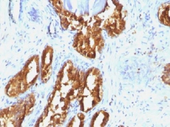 IHC testing of human prostate carcinoma with PSAP antibody (clone ACPP/1338). Required HIER: boil tissue sections in pH 9 10mM Tris with 1mM EDTA for 10-20 min followed by cooling at RT for 20 min.~