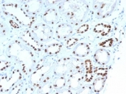 IHC testing of FFPE human renal cell carcinoma with PAX8 antibody (clone PAX8/1492). Required HIER: boil tissue sections in 10mM Tris buffer with 1mM EDTA, pH 9, for 10-20 min followed by cooling at RT for 20 minutes.