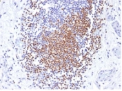 IHC testing of FFPE human urothelial carcinoma with PAX8 antibody (clone PAX8/1492). Required HIER: boil tissue sections in 10mM Tris buffer with 1mM EDTA, pH 9, for 10-20 min followed by cooling at RT for 20 minutes.