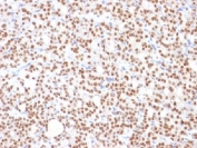 IHC testing of FFPE human thyroid carcinoma with PAX8 antibody (clone PAX8/1492). Required HIER: boil tissue sections in 10mM Tris buffer with 1mM EDTA, pH 9, for 10-20 min followed by cooling at RT for 20 minutes.