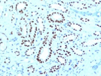 IHC testing of FFPE human renal cell carcinoma with PAX8 antibody cocktail (clone PAX8-1491 + PAX8/1492). Required HIER: boil tissue sections in 10mM Tris buffer with 1mM EDTA, pH 9, for 10-20 min followed by cooling at RT for 20 minutes.~