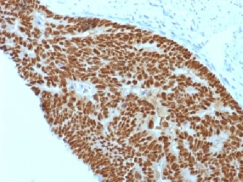 IHC testing of FFPE human colon carcinoma with CDX2 antibody (clone CDX2/1690). Required HIER: boil sections in 10mM citrate buffer, pH6, for 10-20 min.~