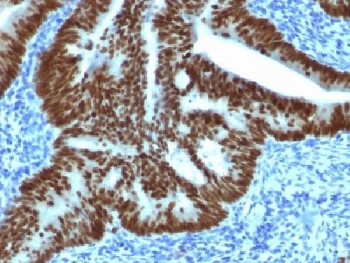 IHC testing of FFPE human colon carcinoma with CDX2 antibody (clone CDX2/1690). Req