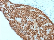IHC testing of FFPE human colon carcinoma with CDX2 antibody (clone CDX2/1690). Required HIER: boil sections in 10mM citrate buffer, pH6, for 10-20 min.