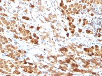 IHC testing of FFPE human melanoma with S100B antibody (clone SPM354). Required HIER: boil tissue sections in pH 9 10mM Tris with 1mM EDTA for 10-20 min followed by cooling at RT for 20 min.~