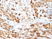IHC testing of FFPE human melanoma with S100B antibody (clone SPM354). Required HIER: boil tissue sections in pH 9 10mM Tris with 1mM EDTA for 10-20 min followed by cooling at RT for 20 min.
