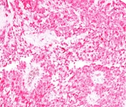 IHC testing of human melanoma stained with S100B antibody + AEC chromogen (clone 4C4.9). No special pretreatment is required for IHC staining of formalin-paraffin tissues.