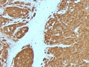 IHC testing of FFPE human melanoma with S100B antibody (4C4.9 + S100B/1012). Required HIER: boiling tissue sections in pH 9 10mM Tris with 1mM EDTA for 10-20 min followed by cooling at RT for 20 min.