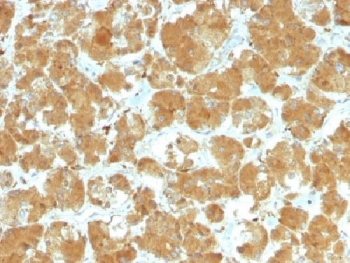 IHC testing of FFPE human thyroid carcinoma with TSHR antibody (clone TSHRA/1402). Required HIER: boil tissue sections in 10mM Tris with 1mM EDTA, pH 9, or 10mM citrate buffer, pH 6, for 10-20 min followed by cooling at RT for 20 min.~