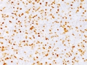 IHC testing of FFPE human bladder carcinoma with TOP2A antibody (clone TOP2A/1362). Required HIER: boil sections in pH 9 10mM Tris with 1mM EDTA for 10-20 min followed by cooling at RT for 20 min.