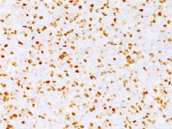 IHC testing of FFPE human bladder carcinoma with TOP2A antibody (clone TOP2A/1362). Required HIER: boil sections in pH 9 10mM Tris with 1mM EDTA for 10-20 min followed by cooling at RT for 20 min.