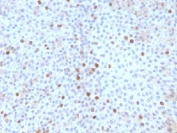IHC testing of FFPE human bladder carcinoma with Topoisomerase II alpha antibody (clone TOP2A/1361). Required HIER: boil sections in pH 9 10mM Tris with 1mM EDTA for 10-20 min followed by cooling at RT for 20 min.