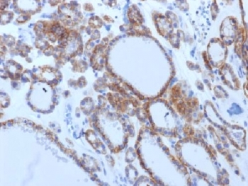 IHC testing of FFPE human thyroid carcinoma with TSHR antibody (clone TSHRB/1405). Required HIER: boil tissue sections in 10mM Tris buffer with 1mM EDTA, pH 8, for 10-20 min followed by cooling at RT for 20 min.~