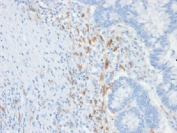 IHC testing of FFPE human colon carcinoma with DC-SIGN antibody (clone C209/1781). Required HIER: boil tissue sections in 10mM Tris with 1mM EDTA, pH 9, for 10-20.