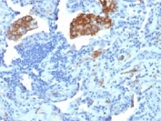 IHC testing of FFPE human lung carcinoma with DC-SIGN antibody (clone C209/1781). Required HIER: boil tissue sections in 10mM Tris with 1mM EDTA, pH 9, for 10-20.