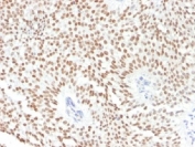 IHC testing of FFPE human bladder carcinoma with FOXA1 antibody (clone FOXA1/1241). HIER: boil sections in 10mM Tris with 1mM EDTA, pH9 for 10-20 min followed by cooling at RT for 20 min.