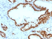 IHC testing of FFPE human prostate carcinoma with FOXA1 antibody (clone FOXA1/1241). HIER: boil sections in 10mM Tris with 1mM EDTA, pH9 for 10-20 min followed by cooling at RT for 20 min.
