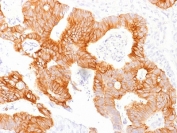 IHC testing of FFPE human colorectal carcinoma and Ep-CAM antibody (clone EGP40/1798). Required HIER: steam sections in pH6 citrate buffer for 10-20 min.
