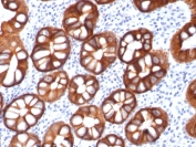 IHC testing of FFPE human colon carcinoma with recombinant EpCAM antibody (clone rMOC-31). Required HIER: boil tissue sections in 10mM citrate buffer, pH 6, for 10-20 min followed by cooling at RT for 20 min.