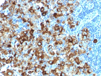 IHC testing of FFPE human melanoma with recombinant gp100 antibody (clone PMEL/1825R). Required HIER: boil tissue sections in 10mM citrate buffer, pH 6, for 10-20 min followed by cooling at RT for 20 min.~