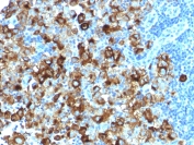 IHC testing of FFPE human melanoma with recombinant gp100 antibody (clone PMEL/1825R). Required HIER: boil tissue sections in 10mM citrate buffer, pH 6, for 10-20 min followed by cooling at RT for 20 min.