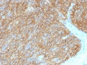 IHC testing of FFPE human gastrointestinal stromal tumor (GIST) with DOG1 antibody (clone DG1/1486). Required HIER: boil tissue sections in pH 9 10mM Tris with 1mM EDTA for 10-20 min.